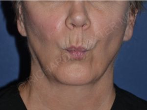 before lip augmentation | lip lift pursed lips view case 4141