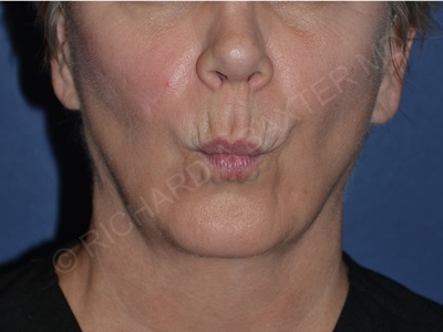 before lip augmentation | lip lift pursed lips view case 4141