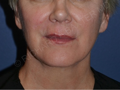 after lip augmentation | lip lift front view case 4141