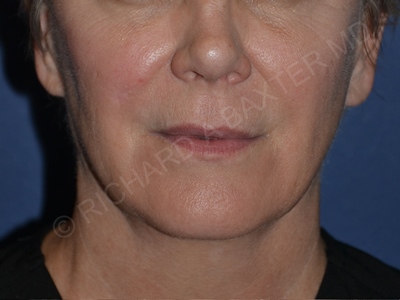 before lip augmentation | lip lift front view case 4141
