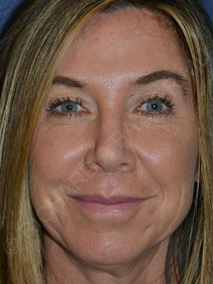 after lip augmentation front view female patient case 5731