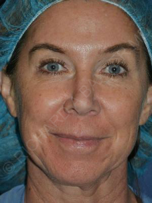 before lip augmentation front view female patient case 5731