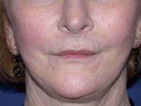 after lip augmentation front view female patient case 5736