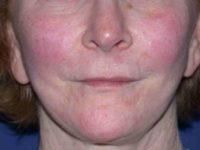before lip augmentation front view female patient case 5736