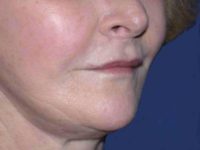 after lip augmentation right angle view female patient case 5736