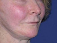 before lip augmentation right angle view female patient case 5736