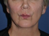 after lip augmentation | lip lift pursed lips view case 4141