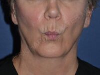 before lip augmentation | lip lift pursed lips view case 4141