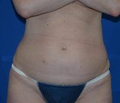 before liposonix case 4050