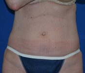 after liposonix case 4050