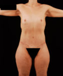 after lower body lift female patient front view case 5441