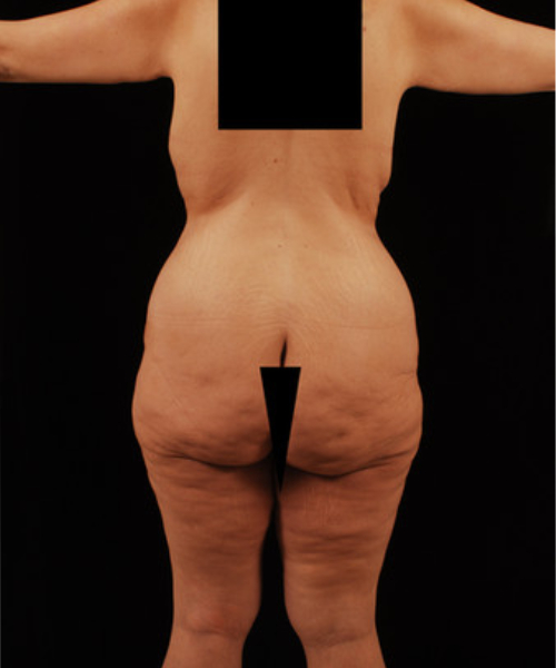 before lower body lift female patient back view case 5441