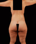 after lower body lift female patient back view case 5441
