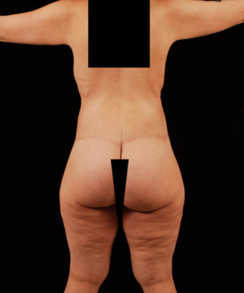after lower body lift female patient back view case 5441