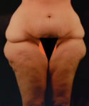 before lower body lift female patient front view case 5446