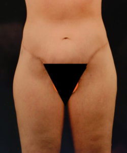 after lower body lift female patient front view case 5446