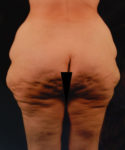 before lower body lift female patient back view case 5446