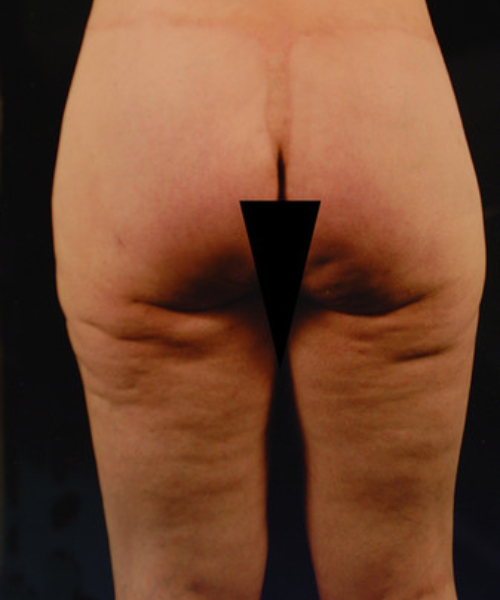 after lower body lift female patient back view case 5446