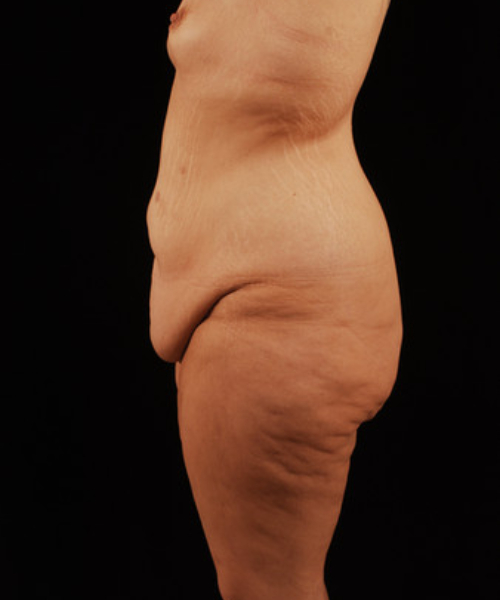 before lower body lift female patient left side view case 5446