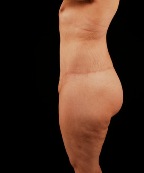 after lower body lift female patient left side view case 5446