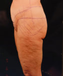 before lower body lift female patient left side view case 5453