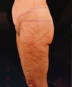 before lower body lift female patient left side view case 5453