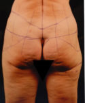 before lower body lift female patient back view case 5453