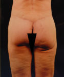 after lower body lift female patient back view case 5453
