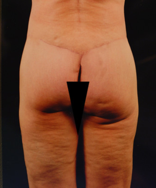 after lower body lift female patient back view case 5453