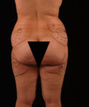 before lower body lift female patient back view case 5458