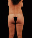 after lower body lift female patient back view case 5458