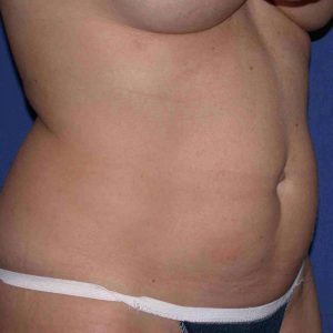 before mini tummy tuck right angle view case 4066