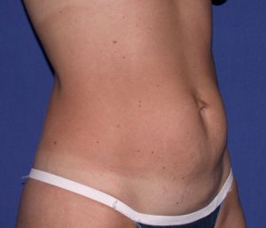 before mini tummy tuck right angle view case 4071