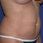before mini tummy tuck right angle view case 4066