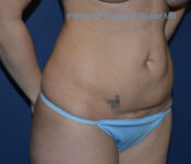 before mini tummy tuck right angle view case 4074