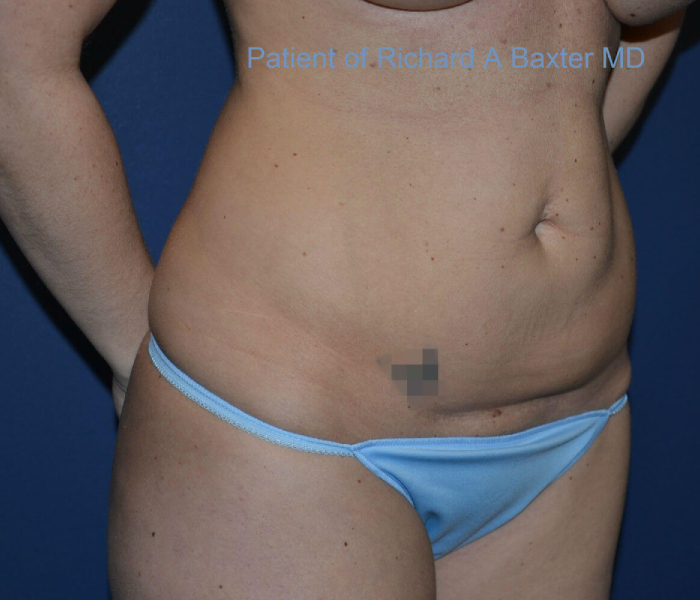before mini tummy tuck right angle view case 4074