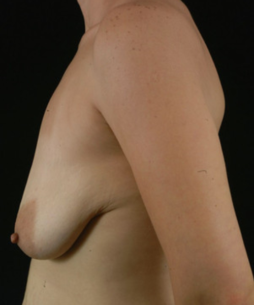 before mommy makeover left side view case 5767