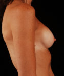 before mommy makeover breast side view case 5781