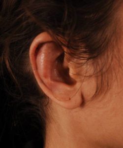 after otoplasty closeup of ear case 4275