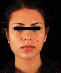 after otoplasty female patient front view case 4278