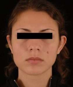 before otoplasty female patient front view case 4278