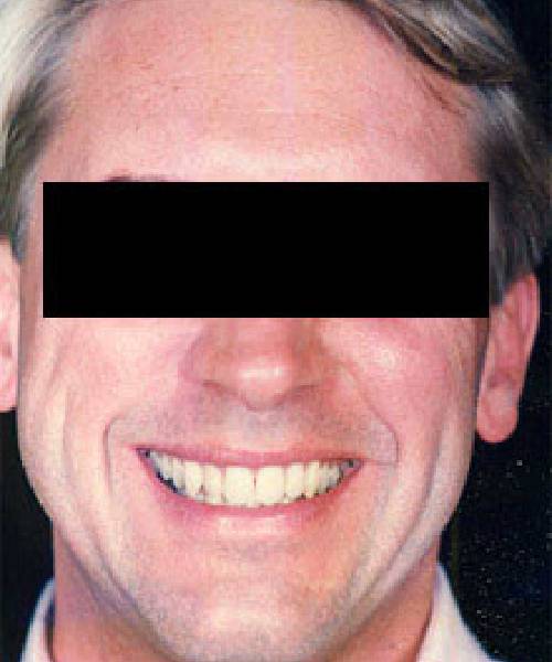 after otoplasty male patient front view case 4281