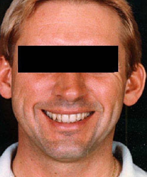 before otoplasty male patient front view case 4281