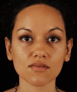 after otoplasty female patient front view case 4287