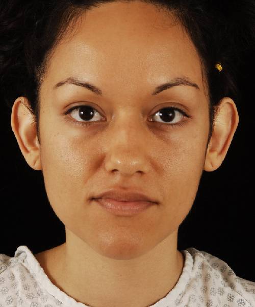 before otoplasty female patient front view case 4287
