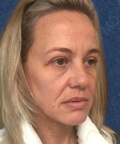 before PRP microneedling | exosome therapy female patient right angle view case 4133