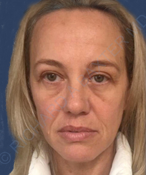 before PRP microneedling | exosome therapy female patient front view case 4133