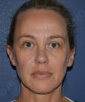 after PRP microneedling | exosome therapy female patient front view case 4133