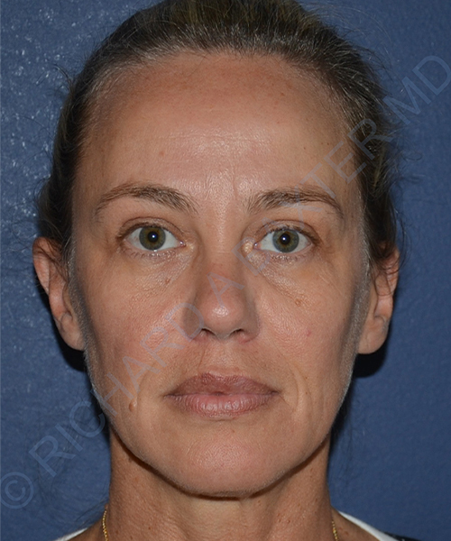 after PRP microneedling | exosome therapy female patient front view case 4133