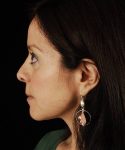 after rhinoplasty female patient left side view case 5163